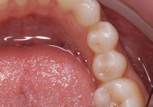 Can a Dentist Fix a Permanent Retainer?
